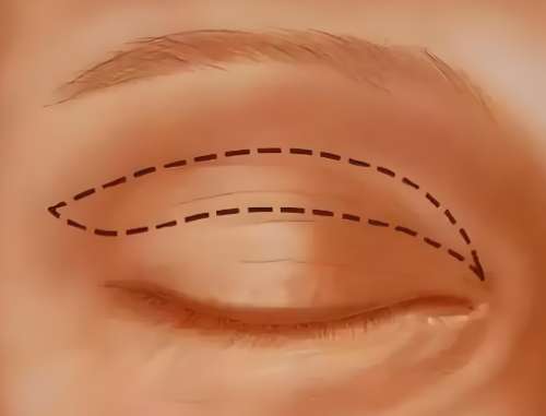 雙眼皮一個(gè)月和三個(gè)月的變化的描述怎么樣？趕緊來看看案例詳情